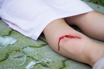 Wundmoulage Schnittwunde mit Glassplitter