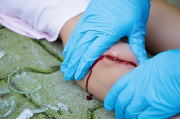 Wundmoulage Schnittwunde mit Glassplitter