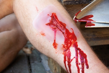 Wundmoulage Risswunde