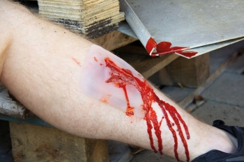 Wundmoulage Risswunde