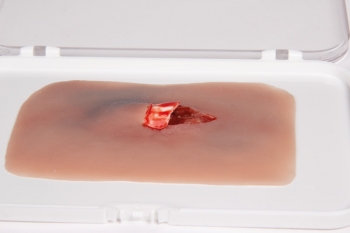 Wundmoulage offener Knochenbruch