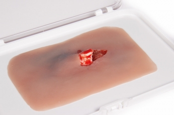 Wundmoulage offener Knochenbruch