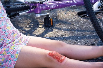 Wundmoulage Schürfwunde