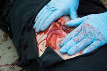 Risswunde groß mit Blutungsfunktion