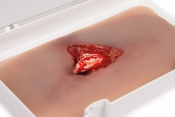 Offener Bruch Bein mit Blutungsfunktion