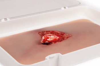 Offener Bruch Bein mit Blutungsfunktion