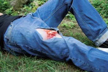 Offener Bruch Bein mit Blutungsfunktion