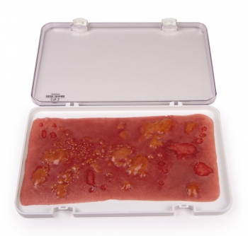 Wundmoulage Verbrennung II. Grades