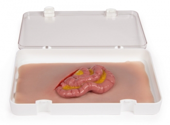 Wundmoulage Dünndarmaustritt