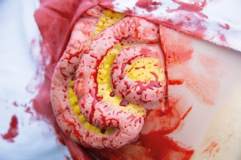 Wundmoulage Dünndarmaustritt