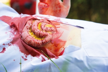 Wundmoulage Dünndarmaustritt