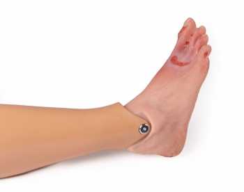 Wundenfuß mit diabetischem Fußsyndrom, fortg. Stadium, Puppenversion