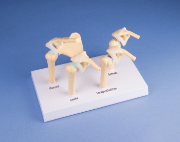 4-Stadien-Osteoarthritis (OA) Schulter