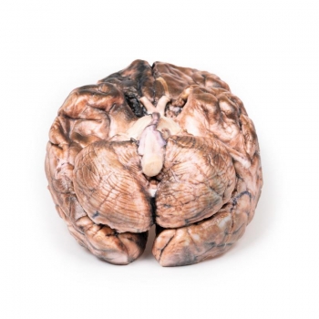 Rupturiertes Berry-Aneurysma