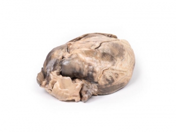 Hypertrophic Subaortic stenosis