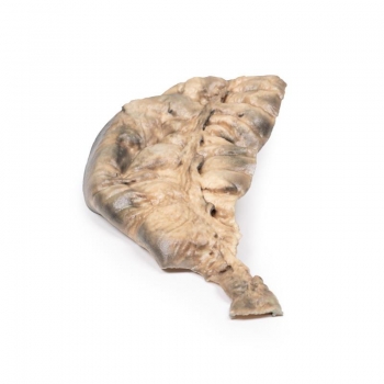 Hirschsprung‘s Krankheit