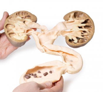 Hydronephrosis Hydroureter