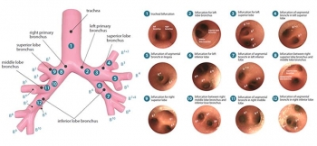 Bronchialbaum für Bronchofiberskopie für R16060