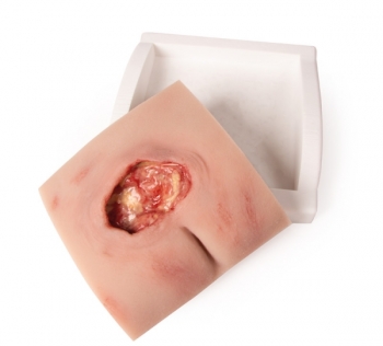 Wundmoulage sakraler Dekubitus gesäubert, mit Stativ