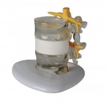 Bandscheiben-Vorfall-Simulator