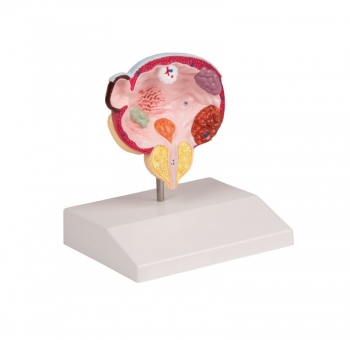 Erkrankungen von Blase und Prostata