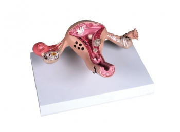 Uterusmodell mit Erkrankungen