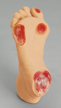 Senioren-Druckgeschwür-Fuß