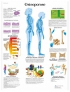 Lehrtafel - Osteoporose 50 x 67 cm