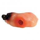 Diabetischer Fuß (fortgeschritten)