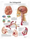 Lehrtafel - Schlaganfall