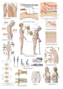 Lehrtafel Osteoporose, 50x70cm (AL504)