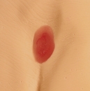 Druckgeschwür / Dekubitus Modelle