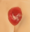 Druckgeschwür / Dekubitus Modelle