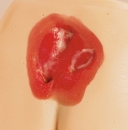 Druckgeschwür / Dekubitus Modelle