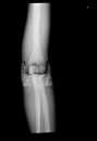 Röntgen-Teilphantom mit künstlichen Knochen - Rechter Ellenbogen
