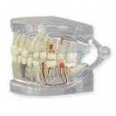 Durchsichtiger menschlicher Kiefer mit Zahnmodell