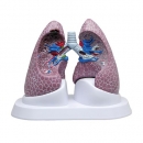Lungen-Set mit Pathologien