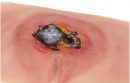 Wundmoulage sakraler Dekubitus, unbehandelt