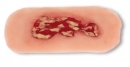Wundmoulage Ulcus Cruris Venosum, klein, Exsudationsphase