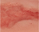 Wundmoulage Ulcus Cruris Venosum, klein, Epithelisierungsphase
