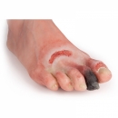 Wundenfuß mit diabetischem Fußsyndrom