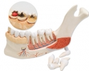 Unterkieferhälfte mit 8 kariösen Zähnen, 19-teilig