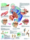 Lehrtafel - Arthrose