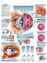 Lehrtafel - Erkrankungen des Auges