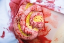 Wundmoulage Dünndarmaustritt