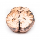 Rupturiertes Berry-Aneurysma