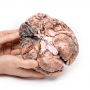 Rupturiertes Berry-Aneurysma