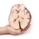 Rupturiertes Berry-Aneurysma