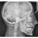 Röntgenphantom Kopf mit Halswirbeln, opak